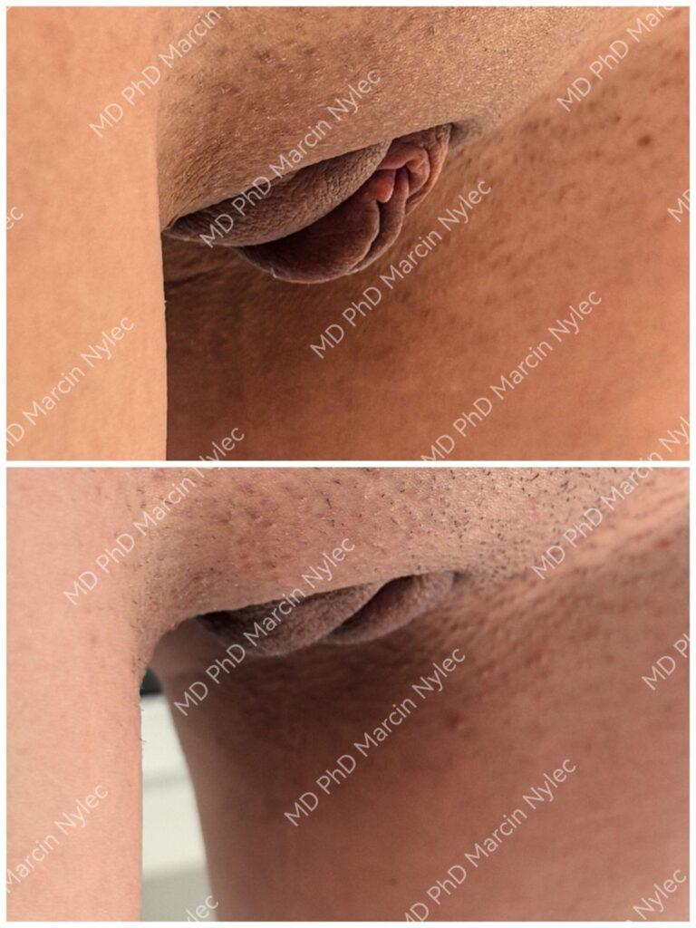 Labioplastyka przed i po, pacjentka #1002, pozycja stojąca, zdjęcie 3 z 8