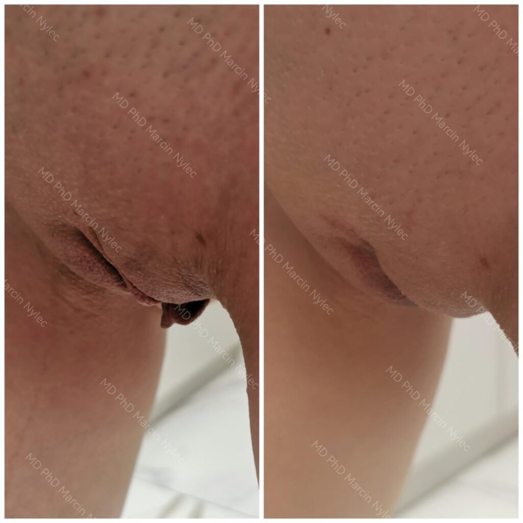 Labioplastyka przed i po, pacjentka #659, pozycja stojąca, zdjęcie 5 z 6
