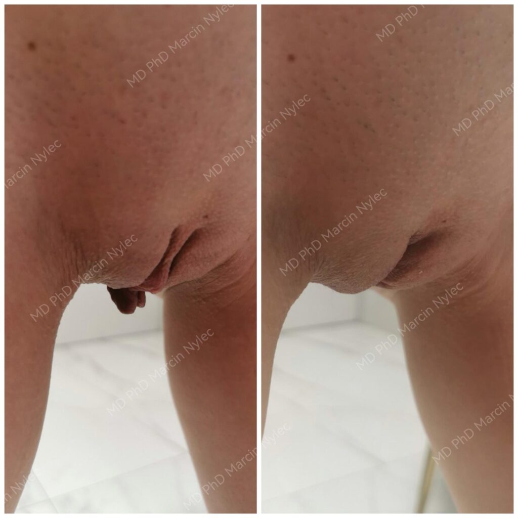 Labioplastyka przed i po, pacjentka #659, pozycja stojąca, zdjęcie 6 z 6
