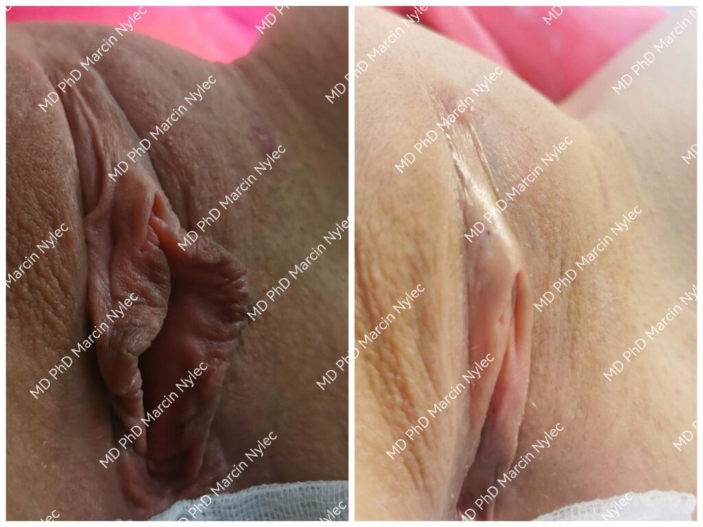Labioplastyka przed i po, pacjentka #702, zbliżenie, zdjęcie 6 z 6