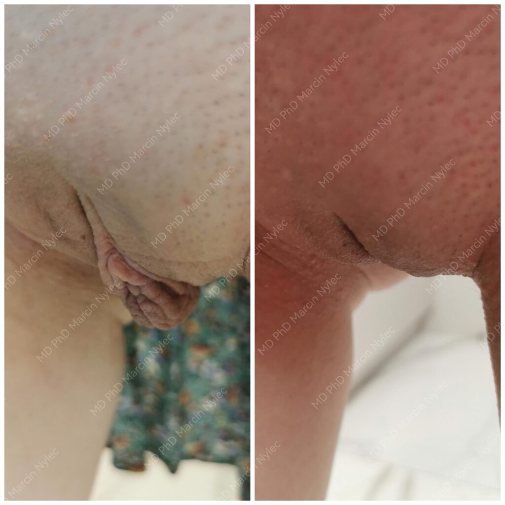 Labioplastyka przed i po, pacjentka #730, pozycja stojąca, zdjęcie 10 z 12