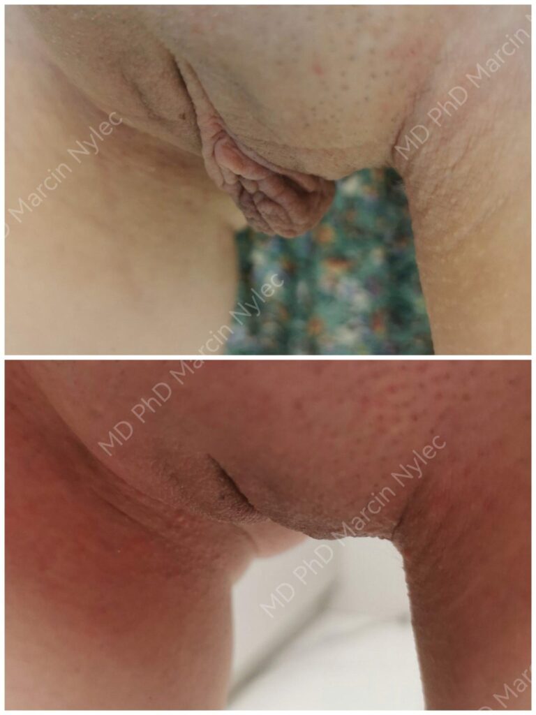 Labioplastyka przed i po, pacjentka #730, pozycja stojąca, zdjęcie 12 z 12