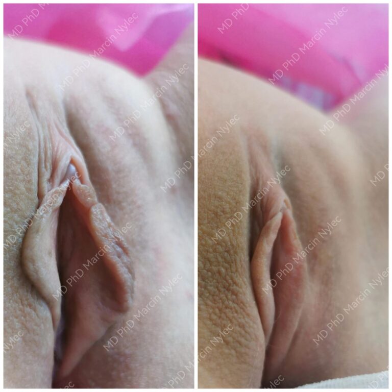 Labioplastyka przed i po, pacjentka #870, zbliżenie, zdjęcie 1 z 4