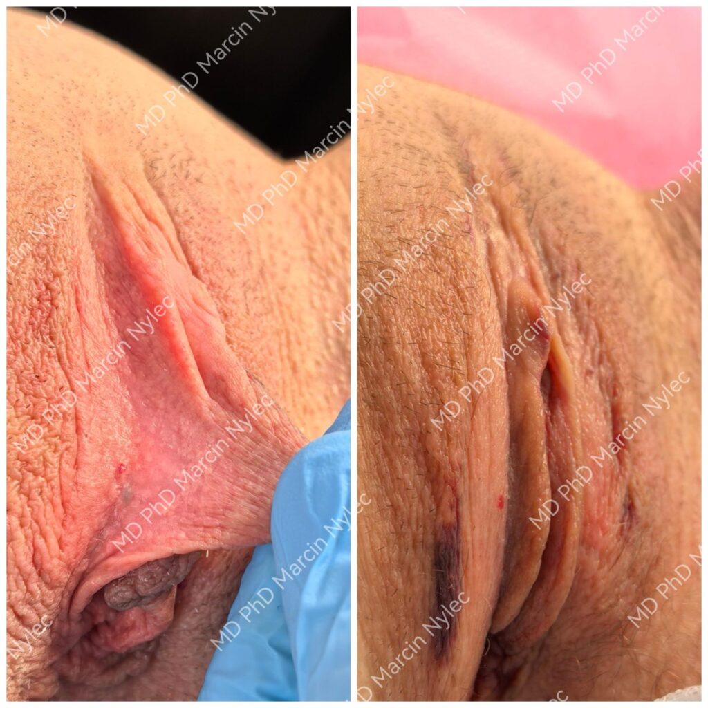 Labioplastyka przed i po, pacjentka #892, zbliżenie, zdjęcie 6 z 6