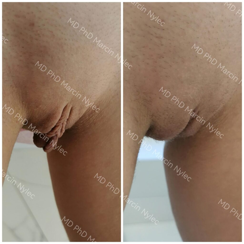Labioplastyka przed i po, pacjentka #959, pozycja stojąca, zdjęcie 7 z 8