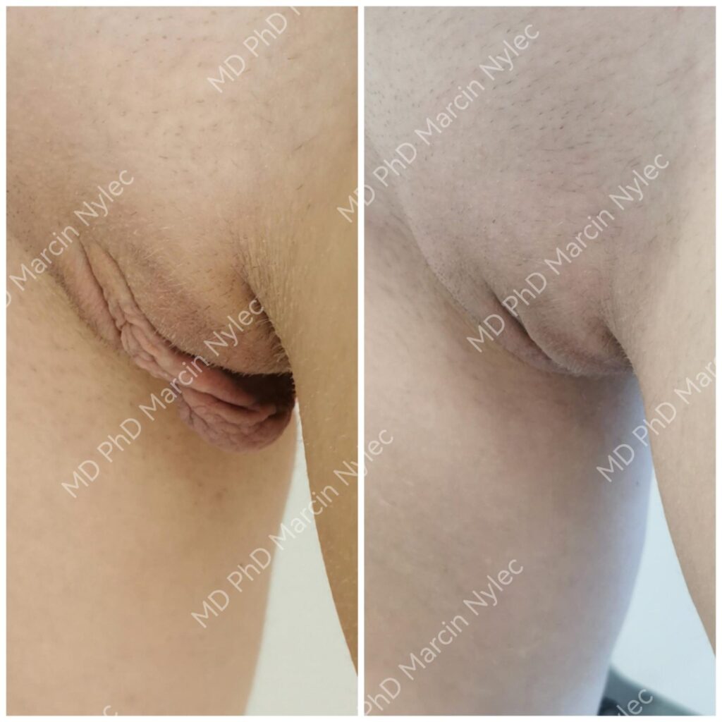 Labioplastyka przed i po, pacjentka #959, pozycja stojąca, zdjęcie 8 z 8