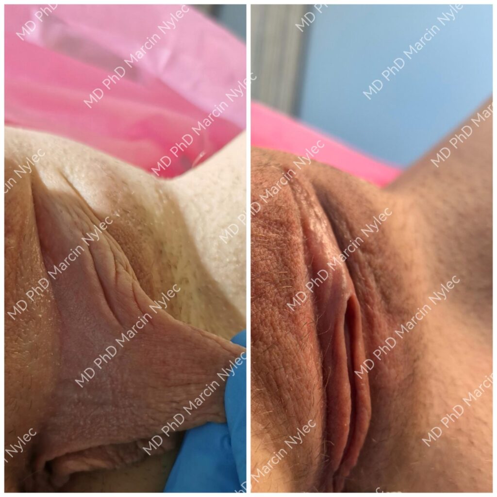 Labioplastyka przed i po, pacjentka #959, zbliżenie, zdjęcie 6 z 8