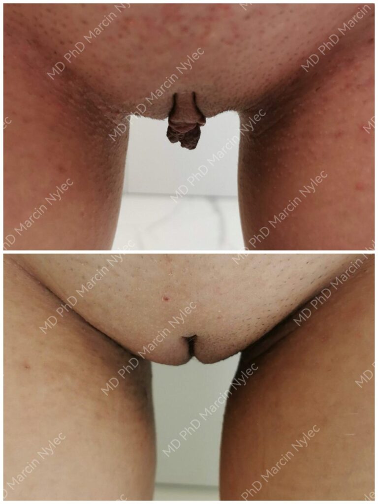 Labioplastyka przed i po, pacjentka #992, pozycja stojąca, zdjęcie 7 z 10