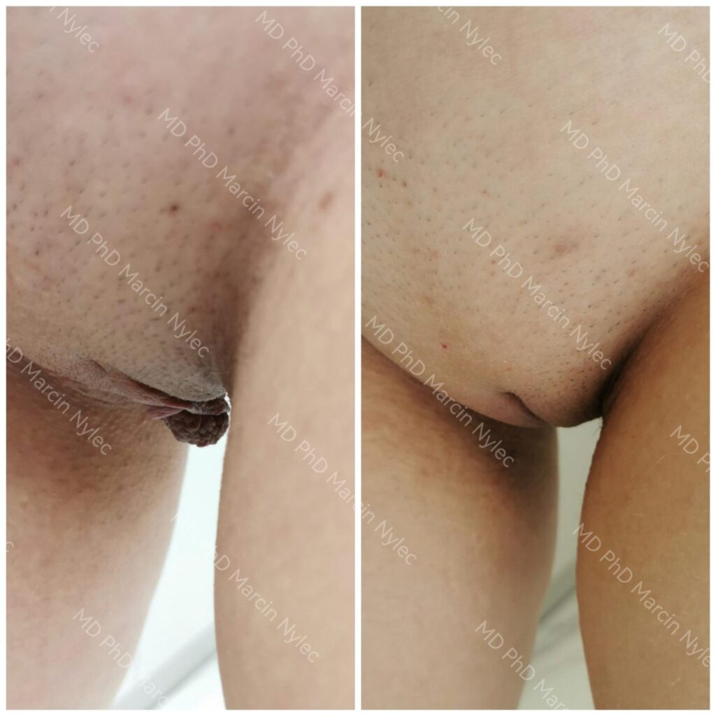 Labioplastyka przed i po, pacjentka #992, pozycja stojąca, zdjęcie 9 z 10