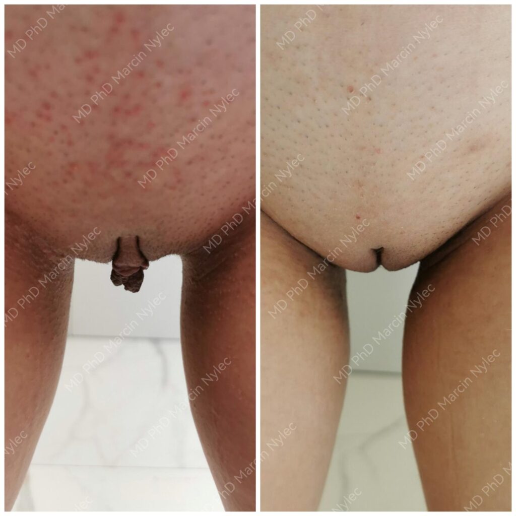 Labioplastyka przed i po, pacjentka #992, pozycja stojąca, zdjęcie 10 z 10